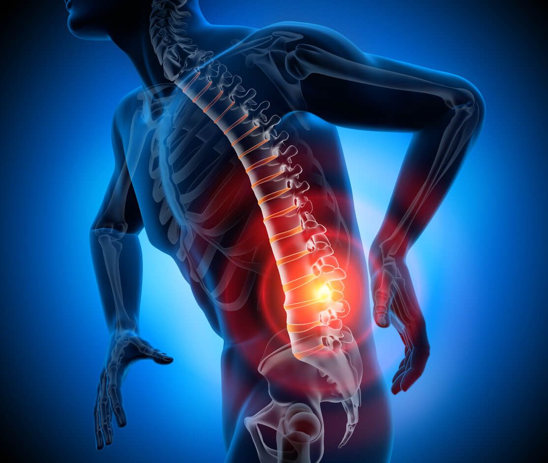 Herniated Disc