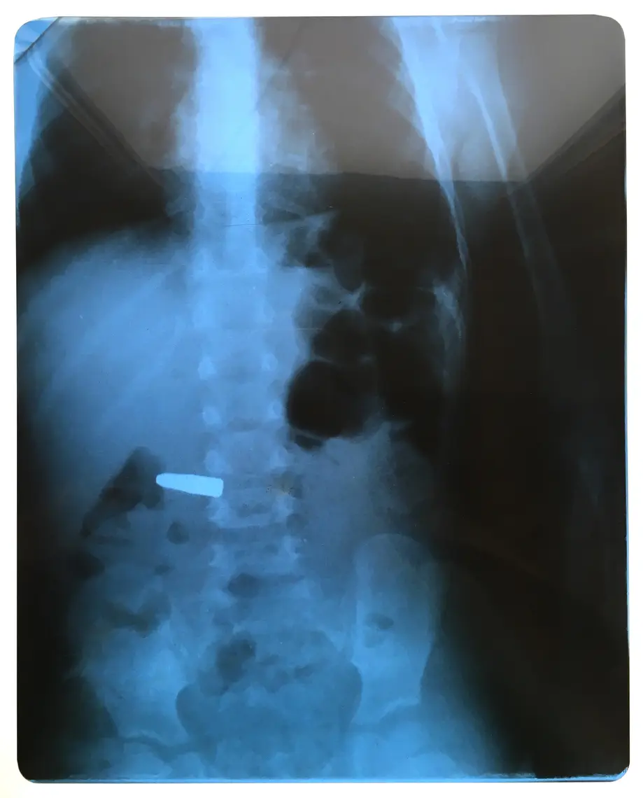 My Doctor Left a Foreign Object Inside Me! What Should I Do Next?